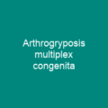 Arthrogryposis multiplex congenita